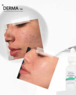 ديرما تن سيروم نياسيناميد 5% لتصغير المسام و تنظيم افرازات الدهون 30 مل - derma 10 - Image 3