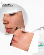 ديرما تن سيروم نياسيناميد 5% لتصغير المسام و تنظيم افرازات الدهون 30 مل - derma 10 - Image 7